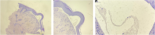 Figure 3 Histopathological result showed subepidermal blister with lymphocytes infiltration in fibromyxoid tissue.