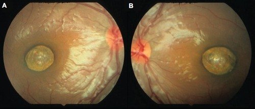 Figure 1 Fundus photographs taken at age 1 year and 4 months.