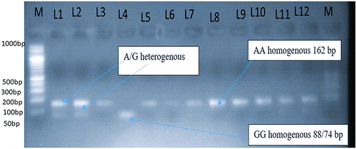 Figure 3 Distribution of CTLA-4 (+A49G) gene polymorphism among diabetes group and controls. Geno typing of CTLA-4 (+A49G) gene polymorphism by BbVI, RFLP. From the left M: marker or ladder DNA fragmented from 100 bp to 3000 bp. Lanes 3,5,6,7,8,9,10 and 11 are band A at162 bp or uncut. Lanes 1, 2 and 12heterozygeous (AG) genotype lane 4: homozygous GG genotype. Fragments of band G at 88 and 74bp appeared as one band due to the very closeness of the band on gel electrophoresis.