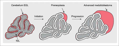 Figure 2. Medulloblastoma formation in Ptch1+/− mice. During postnatal development, granule cell precursors (GCPs) of the cerebellum, the cells of origin of Shh medulloblastoma, are located in the external granule-cell layer (EGL). After their proliferation, most GCPs differentiate, populate the internal granule-cell layer (IGL), and disappear from the EGL after the second postnatal week in the mouse. LOH of the Ptch1 wild-type allele causes a clonal expansion and leads to the formation of preneoplasia. While most preneoplastic lesions disappear, some of them progress to advanced medulloblastoma. See also Figure 1B.