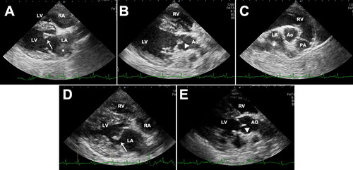 Figure 2. Two-dimensional echocardiographic images of the right parasternal long-axis four-chamber view (A), right parasternal long-axis five-chamber view (B), right parasternal short-axis view (C), thickened anterior leaflet of mitral valves (arrow), and the noncoronary cusp of aortic valves (arrow head) with irregular and hyperechoic vegetative lesions in a 8-year-old, spayed, female Maltese dog. Left atrial thrombus was confirmed (asterisk). Echocardiogram images of the right parasternal long-axis four-chamber view (D) and right parasternal long-axis five-chamber view (E) after 4 months follow-up. The thickening of anterior leaflet of mitral valves (arrow) was still identified, but vegetative lesions of the noncoronary cusp of aortic valve (arrow head) were not found. Decreased size of thrombus was confirmed in the left atrium. LV, left ventricle; RV, right ventricle, LA, left atrium, RA, right atrium; Ao, aorta.