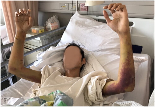 Figure 1. Clinical Photo of patient on admission. There was marked swelling, bruising over bilateral forearms.