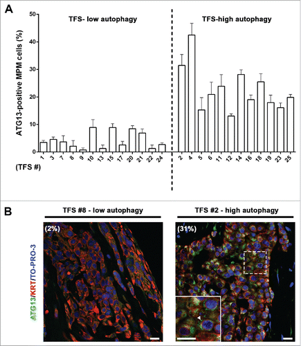 Figure 5. In tumor fragment spheroids, ATG13 puncta analysis reflects the low or high levels of autophagy. The TFS shown in Figure 4 and not exposed to ammonium chloride (NH4+) were fixed, embedded in paraffin, stained for ATG13 (green), KRT/cytokeratin to identify mesothelioma cells (red) and nuclei (blue), and imaged by confocal microscopy. (A) Bars represent the mean percentage of ATG13-positive MPM cells for the TFS determined in Figure 4 to be low or high ATG. Error bars, SEM (B) Representative images of TFS with either low autophagy (TFS #8) or high autophagy (TFS #2) levels are shown, with the percentage of mesothelioma cells with ATG13 puncta (ATG13-positive MPM cells) indicated in parentheses. Zoom-in view of the region in the dashed box shows representative cells with ATG13 puncta (arrowhead). Scale bars: 10 µm.