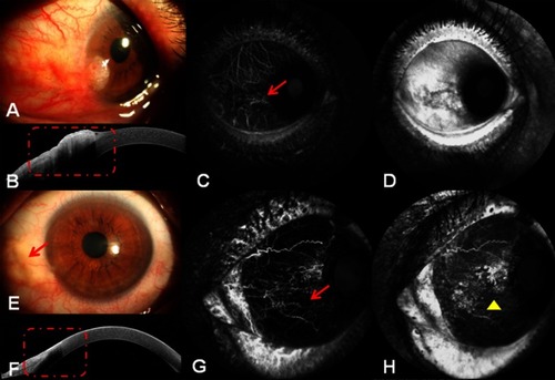 Figure 5 Anterior segment images of Case 4 (left eye). (A) A large papillomatous red tumor involving the cornea, limbus, and conjunctiva. (B) AS-OCT demonstrated an abrupt transition between unremarkable and thickened hyper-reflective epithelia. However, in this large lesion, a shadow from the hyper-reflective epithelium sometimes obscured the plane of cleavage (red dots). (C) ICGA showed both focal pattern intratumoral vessels clearly (red arrow). (D) Leakage from the tumor was observed via FA. (E) The tumor completely disappeared after treatment, with palpebral fissures remaining in the primary tumor area (red arrow). (F) No clinical signs of the lesion were present on the AS-OCT image (red dots). (G) Both intratumoral vessels and conjunctival feeding vessels disappeared, and only the patched ischemic region remained (red arrow), evident on anterior segment ICGA images, after treatment. (H) No leakage was found using FA after treatment.Abbreviations: AS-OCT, anterior segment optical coherence tomography; FA, fluorescein angiography; ICGA, conjunctival indocyanine green angiography.
