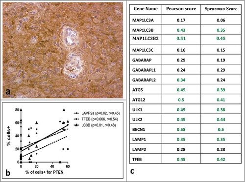 Figure 6. Immunohistochemical image of glioblastoma stained for PTEN (A). Correlation of PTEN expression with auto-lysosomal markers in immunohistochemical data (B) and in gene expression data (C).