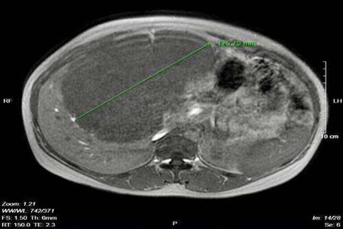 Figure 2 Liver tumor on T1 in-phase.