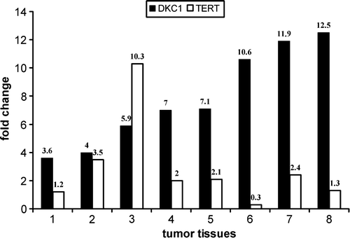 Figure 1.  Expression level of TERT and DKC1 mRNA in colon tumor tissues compared to each matched normal mucosa. This experiment was performed three times with similar results. A typical experiment is shown.