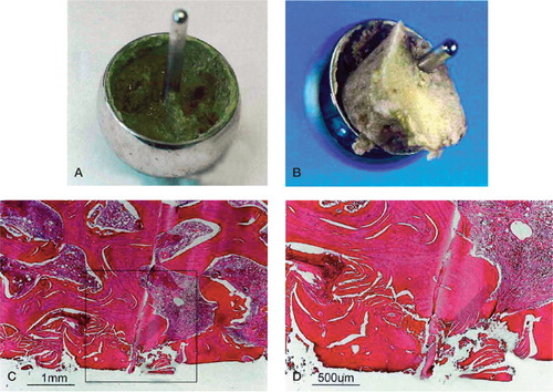 Figure 2. A. Macroscopic view of the tissue in the femoral prosthetic component. B. Macroscopic view of the tissue in the prosthesis with the remaining part of the femoral neck. C. Histological analysis revealed zones of tissue with non-vital bone, where no vital osteocytes could be observed. The local bone necrosis was in direct contact with the stem of the prosthesis. D. Enlargement of the previous micrograph showing bony tissue without living cells.