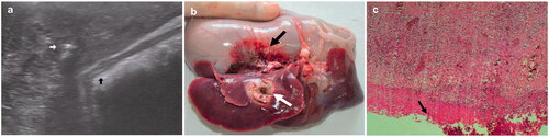 Figure 5. (a) Ultrasonographic image showing that the distance between the ablation needle (white arrow) and the stomach wall (blue arrow) was approximately 5 mm. (b) Photograph showing the ablation areas (white arrow) and the adjacent stomach wall (black arrow). (c) Histopathological examination showing injury to the mucous layer of the stomach wall (black arrow). For interpretation of the references to colour in this figure legend, please refer to the web version of this article at informahealthcare.com.