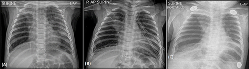 Figure 1 (A) Left lung hyperinflation and reduced right lung volume along with upper lobe haziness or atelectasis, (B) 12 days later, upper lobe haziness has slightly decreased with an overall decrease in infiltrations along the lung, (C) right upper lobe haziness reappears with widespread lung consolidation and indistinct heart borders.