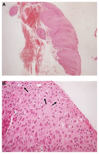 Figure 2 (A) Benign squamous papilloma of patient 1. The papillary growth pattern is apparent. Extensive hyperplastic epithelium with papillomatosis and acanthosis is observed (hematoxylin and eosin staining, ×40) and (B) Koilocytosis (arrows) with mild nuclear atypia is observed in the benign squamous papilloma of patient 1 (hematoxylin and eosin staining, ×400).