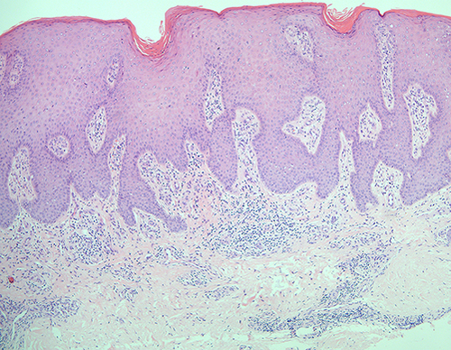 Figure 3 Histopathology showed psoriasiform acanthosis with a diminished granular layer, lymphocyte infiltration in the superficial dermis. (HE stain, magnification 4*10).