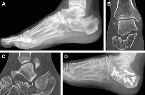 Figure 1 (A) Preoperative X-ray of a patient with Sanders Type 4 calcaneal fracture, (B and C) preoperative coronal and sagittal CT images of the same patient, (D) early postoperative X-ray of the patient.