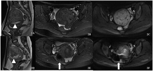Figure 2. Patient number 125, 39 years old. (A–C) MR images before HIFU treatment; (D–F) MR images after HIFU treatment. A sagittal T2-weighted image (A) demonstrates anterior wall fibroids (triangle) that are almost hypointense on T2-weighted scans; (C) is a diffusion-weighted image. Fascial swelling has a stripe-like high-intensity signal (long arrow).