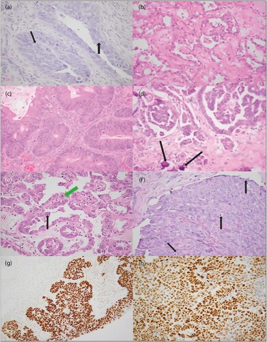 Figure 5: Photomicrographs of malignant ovarian neoplasms. A shows gland formation (arrows) in an ovarian EC. B shows nuclear atypia and clear to lightly eosinophilic cytoplasm in an ovarian CCC. C shows atypical mucinous glands in an ovarian MC. D shows LGSC with moderate cytological atypia and an induced stromal response. Foci of psammomatous calcification are shown (arrows). E shows multinucleation (black arrow) and prominent nucleoli (green arrow) indicating high-grade, bizarre cytomorphology in ovarian HGSC. F shows a solid growth pattern of ovarian HGSC, in comparison with the micropapillary architecture of HGSC shown in E. Numerous mitotic figures are seen in one field (arrows). G shows diffuse, homogenous nuclear staining for P53, indicating TP53 mutation. H shows strong nuclear positivity for WT-1 (original magnification: A, B, C, D, E, F and H: x400, G x200).