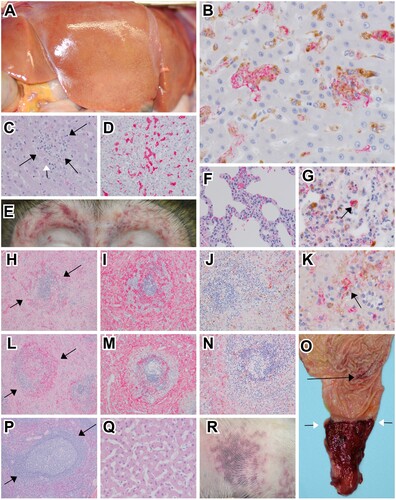 Figure 3. Representative gross and histologic lesions of SUDV-infected macaques. (A) Diffuse hepatic pallor indicative of hepatitis in cynomolgus macaque (RHES-1). (B) Immunohistochemistry (IHC) double labelling for macrophage (CD68-brown) and SUDV VP40 (red) in the liver of rhesus macaque (RHES-6) 40x, normal hepatic architecture was disrupted with expanded sinusoids that were occupied with clusters of macrophages infected with SUDV. (C) Hematoxylin and eosin (H&E) staining of the liver in rhesus macaque (RHES-6) 40x, normal hepatic architecture was disrupted with expanded sinusoids with mononuclear inflammation and eosinophilic cellular debris (black arrows), rarely eosinophilic intracytoplasmic inclusion bodies were noted (white arrow). (D) IHC for fibrin (red) in rhesus macaque (RHES-6) 20x, intra-sinusoidual fibrin deposition. (E) Bilateral periorbital petechial rash in rhesus macaque (RHES-2). (F) H&E staining of lung in cynomolgus macaque (CYNO-9) 40x, expansion of alveolar septa with mononuclear inflammatory cells and minimal extravasation of erythrocytes within alveoli. (G) IHC double labelling for macrophage (CD68-brown) and SUDV VP40 (red) in the lung of cynomolgus macaque (CYNO-9) 60x, alveolar macrophages were infected with SUDV (black arrow). (H) H&E staining of spleen in rhesus macaque (RHES-6) 10x, loss of normal white pulp architecture with extensive lymphocytolysis, hemorrhage and fibrin deposition (black arrows). (I) IHC labelling for fibrin (red) in the spleen of rhesus macaque (RHES-6) 10x, extensive fibrin deposition in red and white pulp. (J) IHC double labelling for macrophage (CD68-brown) and SUDV VP40 (red) in the spleen of rhesus macaque (RHES-6) 20x, macrophages infected with SUDV were sparsely present in the red and white pulp. (K) Higher magnification of IHC double labelling for macrophage (CD68-brown) and SUDV VP40 (red) in the spleen of rhesus macaque (RHES-6) 60x, macrophages infected with SUDV (black arrow). (L) H&E staining of spleen in cynomolgus macaque (CYNO-9) 10x, loss of normal white pulp architecture with extensive lymphocytolysis, hemorrhage and fibrin deposition (black arrows). (M) IHC labelling for fibrin (red) in the spleen of cynomolgus macaque (CYNO-9) 10x, extensive fibrin deposition in red and white pulp. (N) IHC double labelling for macrophage (CD68-brown) and SUDV VP40 (red) in the spleen of cynomolgus macaque (CYNO-9) 20x, macrophages infected with SUDV were sparsely present in the red and white pulp. (O) Mucosal surface of the pyloric region of the stomach and aboral duodenum in rhesus macaque (RHES-2), multifocal pinpoint ulcerations of the gastric mucosa (black arrow) and diffuse ulceration and hemorrhage of the aboral duodenum extending up to the pyloric sphincter (white arrows). (P) H&E staining of spleen in SUDV survivor rhesus macaque (RHES-7) 10x, no signification lesions. (Q) H&E staining of liver in SUDV survivor rhesus macaque (RHES-7) 10x, no signification lesions. (R) Petechial rash of the extremity in rhesus macaque (RHES-2).