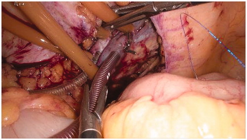 Figure 4. Introduction of cannulae inside the external iliac vessels.