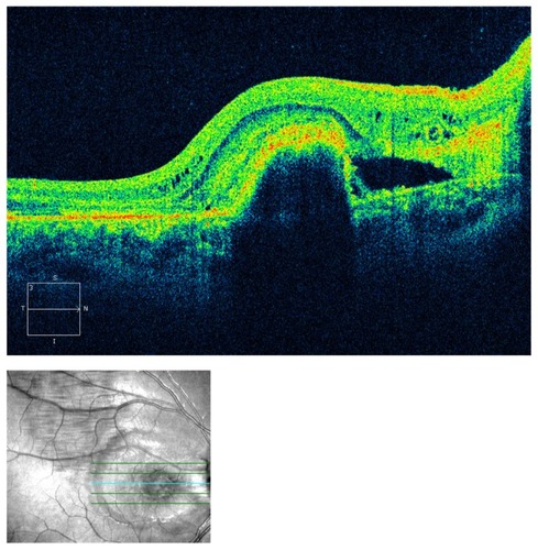 Figure 7 Optical coherence tomography of the right eye.