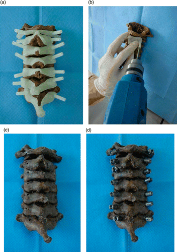 Figure 5. (a) The navigational templates fitted perfectly onto the posterior surface of their corresponding vertebrae. (b) A high-speed drill was used along the navigational channel to drill the trajectory of the pedicle screw. (c) Pedicle channel of cervical spine specimen. (d) Pedicle screws inserted into the cervical spine specimens.
