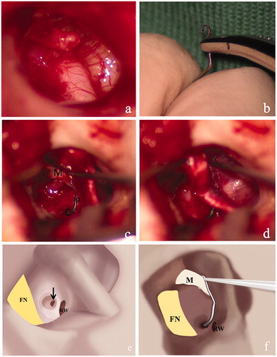 Figure 1. The facial nerve occupied the atresia plate and part of the promontory (a, e) with dehiscence. The titanium stapes prothesss was shaped with two curves in different planes (b, f). The prothesis connected the scale tympani opening and the manubrium of malleus (c, f). The connection of the chain with 45° hook (d). I: incus; M: malleus; P: prothesis; C: cochleostomy; FN: facial nerve; RW: round window; TM: tympanic membrane. Black arrow: cochleostomy on the lateral wall of basal scala tympani.