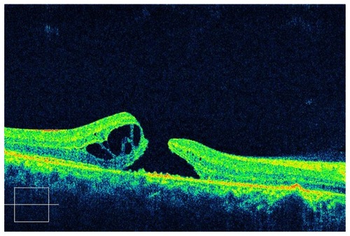 Figure 1 Preoperative OCT of traumatic macular hole with silicone oil tamponade.