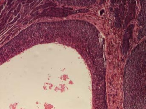 Figure 2 Proliferation of basaloid cell with palisading disposition (hematoxylin and eosin, 40×).