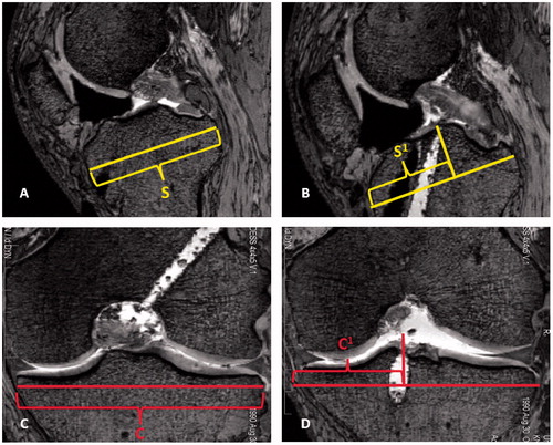 Figure 3. Tibial measurements were made using sagittal and coronal MR images. The maximum sagittal width of the tibia parallel to the joint line, S, was measured and copied to all images (A). The slice at which the AM or PL tunnel broke the subchondral bone of the tibial plateau was located and measured perpendicular to line S. The distance S1 was expressed as a percentage of the maximum sagittal width (B). The maximum coronal width was measured and represented by line C (C). The slice at which the AM or PL tunnel broke the subchondral bone was identified and measured perpendicular to line C. The distance C1 was expressed as a percentage of the maximum coronal width (D).
