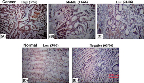 Figure 1. Images of immunohistochemical expression of CDKL1 in human gastric cancer compared with matched adjacent tissues. The specimens were viewed with an Olympus CKX41 microscope at magnification of 20 ×. (A, B, C) Representative photos of high-level, middle-level and low-level expression of CDKL1 protein in human gastric cancer. (D, E) Representative photos of low-level and negative expression of CDKL1 protein in adjacent tissues.