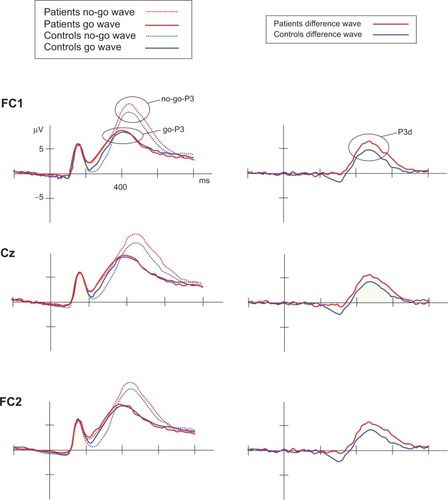 Figure 2 Original go/no-go P3 waves in the patient and control groups and resulting P3d waves at the FC1, FC2, and Cz sites.