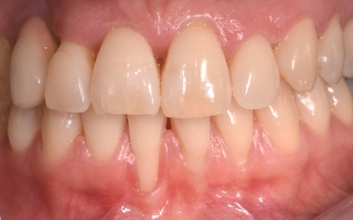 Figure 1 Gingival recession in tooth 4.1.