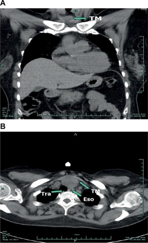 Figure 1 (A) Chest contrast-enhanced CT scan in the sagittal planes indicate the tumor. (B) CT in the coronal planes before surgery showing a mass lesion in the anterosuperior mediastinum.Abbreviations: CT, computed tomography; Eso, espohagus; Tra, trachea; TM, tumor.