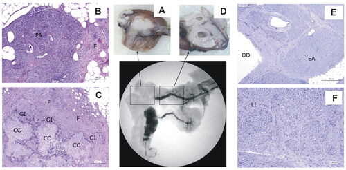Figure 10. Animal model results. Histopathological findings of Group 30-day, distinguishing the ablation zone (A–C) and the distal zone (D − F). (A) Macroscopic view of the ablation zone. (B,C) Histological image (H&E). (B) Residual pancreatic tissue (PA) tissue with intense fibrosis (F). (C) Granulomas with cholesterol crystals (CC) surrounded by a granulomatous infiltrate (GI), with macrophages and giant cells and intense fibrosis (F). (D) Macroscopic view of distal portion in the main pancreas showing ducts dilation. (E,F) Histological image (H&E). (E) Ducts dilatation (DD) and complete and homogeneous exocrine atrophy (EA). (F) Langerhans islets (LI) preservation.