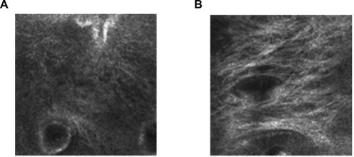 Figure 2 Photographs of dermis with confocal reflectance microscopy.