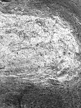 FIG. 3 Microscopic appearance of low-grade fibromyxoid sarcoma: showing bland uniform spindle cells arranged in a swirling pattern and embedded in an alternating myxoid and fibrosing stroma (×40;FMS9).