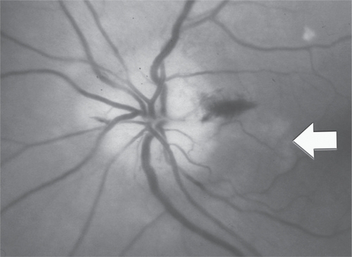Figure 4 Disc swelling in GCA. Note pallid disc swelling with hemorrhages and an adjacent area of choroidal infarction (arrow) (courtesy of Peter J Savino, MD).
