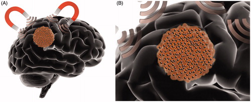 Figure 2. Schematic representation of magnetic hyperthermia therapy in the brain. (A) Alternating magnetic field is applied to the patient after local administration of magnetic nanoparticles (black spheres), generating highly localized hyperthermia. (B) Heat is produced via hysteresis losses and Brownian relaxation (a process in which frictional heating is generated by the physical rotation of the magnetic particle).