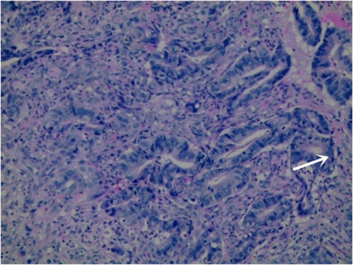 Figure 1 There were more adulterants in the thyroid gland, with disordered arrangement, some glands fused, and obvious cell atypia. The arrow indicates the heterocyst.