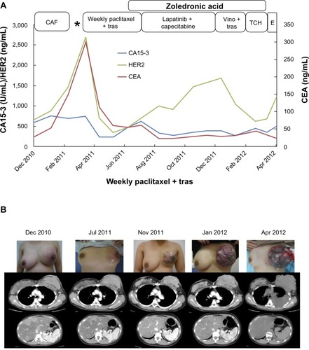 Figure 1 The patient’s clinical course before administration of paclitaxel and bevacizumab.