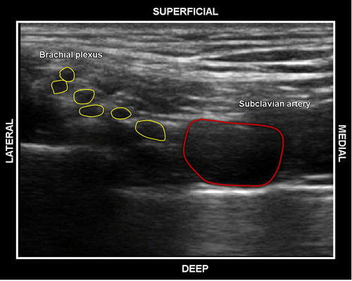 Figure 6: BP (grape-like appearance) found posterolateral to the SCA.