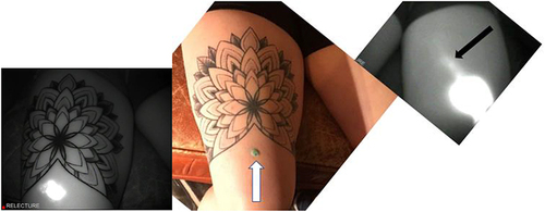 Figure 3 Abnormality type 1. The NIRFI pictures show (left sided black and white picture) no Lymphatic Vessel (LV) (subject j9) under the tattoo at the level of the right anterior and proximal right thigh while on the opposite side (right sided black and white picture) the draining LV is seen (see black arrow) before diving deep and disappearing.