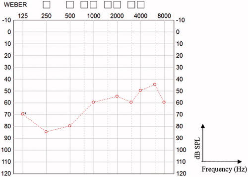 Figure 4. Hearing thresholds with the ABI, 12 months after re-implantation.