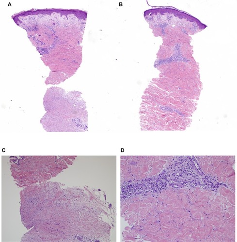 Figure 3 (A) Skin biopsy – leg (×40 magnification), (B) skin biopsy – abdomen (×40 magnification), (C) deep skin biopsy – leg (×100 magnification), and (D) perivascular and thickened collagen – abdomen (×200 magnification).