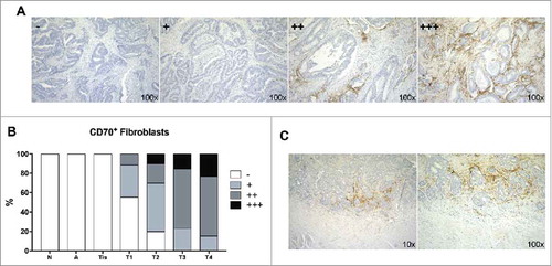Figure 1. CD70 expression determined by immunohistochemistry. A: Representative samples of the various categories of CD70 expression, graded as - (<1%), 1+ (1–10%), 2+ (11–50%), 3+ (>50%); B: Graph displaying the expression of CD70 in normal (N), adenoma (A), in situ carcinoma (Tis) and invasive (T1-T4) CRC specimens; C: CD70 expression at the invasive front of the tumor. Magnitude is depicted at the bottom right.