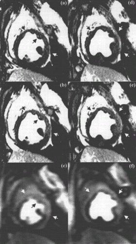Figure 1. Examples from two different occlusion studies: (a) T2-prepared TrueFISP BOLD image at baseline, (b) T2-prepared TrueFISP BOLD image at stress-occlusion, (c) SR-TrueFISP first-pass perfusion at stress-occlusion, (d) T2-prepared TrueFISP BOLD image at baseline, (e) T2-prepared TrueFISP BOLD image at stress-occlusion, (f) SR-TrueFISP first-pass perfusion at stress-occlusion. Notice the regions with increased signal (arrows), indicating vasodilation.