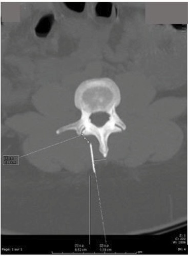 Figure 2 A lumbar spine CT scan.