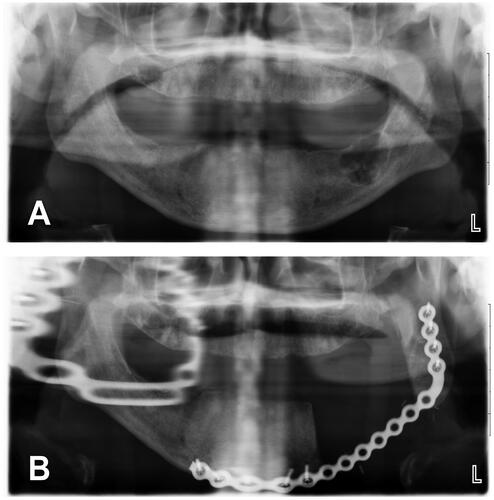 Figure 1. (A) A 66-year-old edentulous male with a 3 × 2.6 cm2 multicystic ameloblastoma of the left mandibular body. Patient consulted 4 months after onset of progressive painless mass. Several comorbidities (high blood pressure, gout, prostate cancer) and permanent use of 6 medications. Chronic consumption of tobacco (1 ppd for 44 years) and alcohol (1–2 beers weekly). BMI of 33 kg/m2. (B) Ameloblastoma was treated with left segmental mandible resection, reconstruction plate and left IAN grafting. Length of stay of 1 day. No postoperative complications.