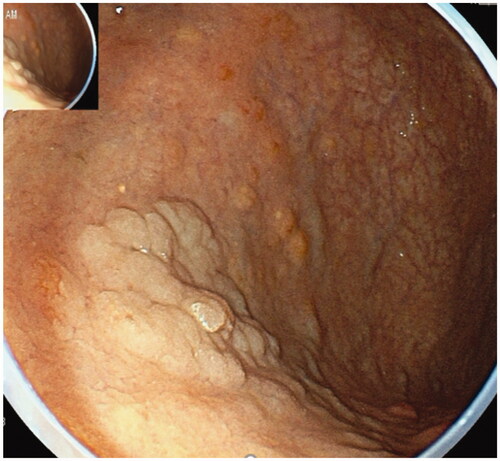 Figure 5. Multiple gastric NETs coexisted with HGD in the corpus were arisen from AMAG.