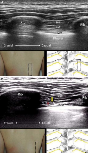 Figure 8 The sagittal plane for the origins (A) and middle portions (B) of the ribs.