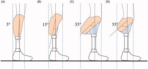 Figure 7. shows different degrees of transfemoral socket flexion and path of the weight line dropping from trochanter, falling in front of the knee and passing through the ankle. The distance between the two dotted lines shows the bulkiness of the socket in which the greatest distance is the bulkiest prosthesis. For the same residual limb length, most bulkiness occurs in the most flexed socket (C > B > A) and, for the same angle, it occurs in the longer residual limb (C > D).