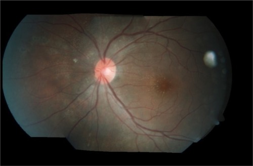 Figure 5 Left fundus showed regression of optic disc swelling with resolving macular star and resolution of crops of choroidal lesions with multiple focal laser scars nasal to the optic disc at 1 month posttreatment.